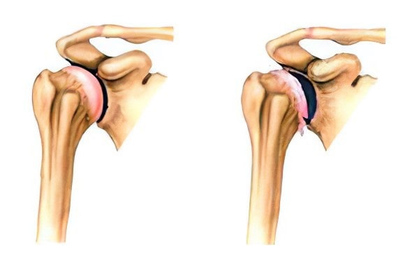 استئوآرتریت شانه (آرتروز)