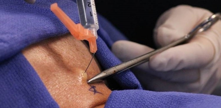 تزریق استروئید برای دیسک گردن