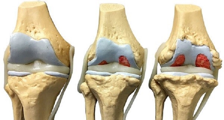 آرتروز زانو چیست و چگونه درمان می‌شود؟