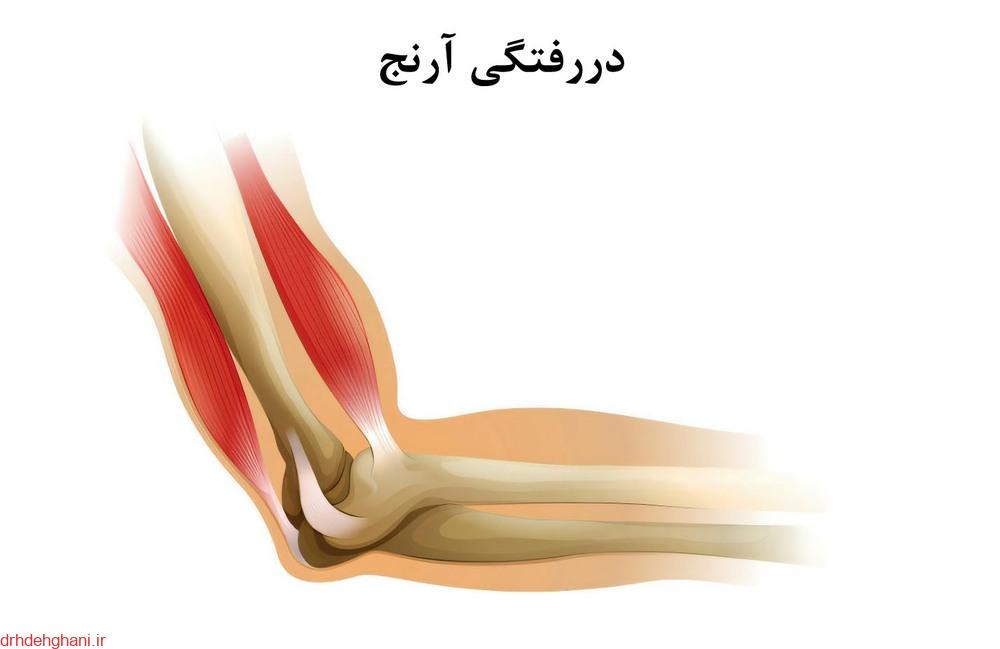 دررفتگی آرنج